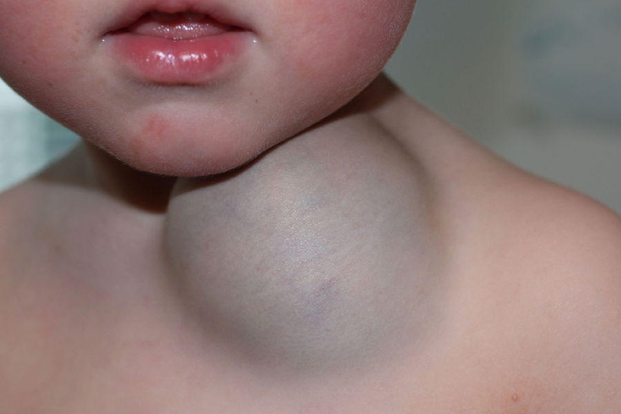 What are vascular malformations?