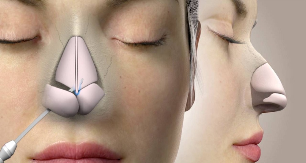 Advantages Of Nose Surgery
