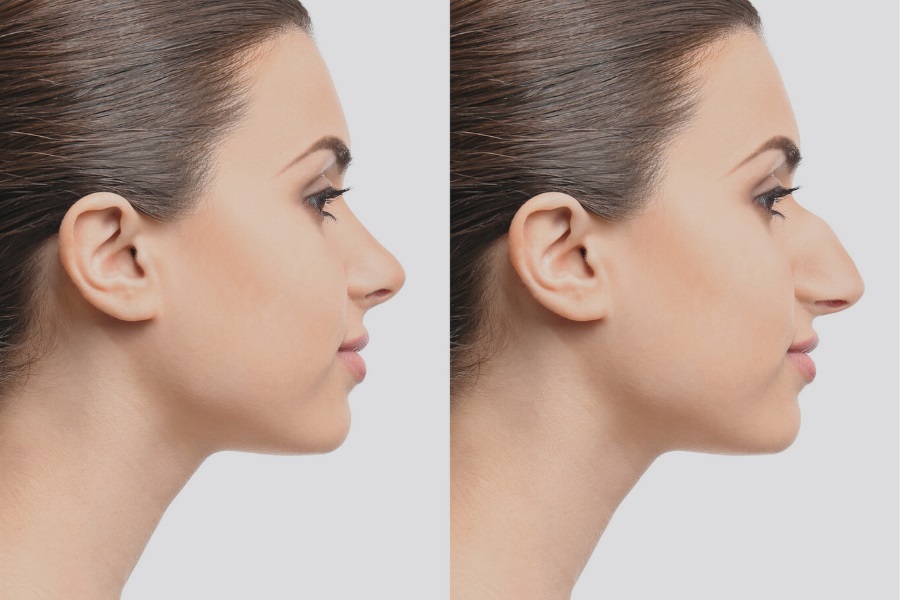 A Proper Nose Surgery Results In A Beautiful Outcome