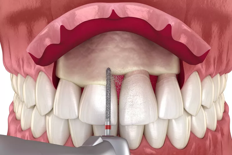 Crown Lengthening: Enhancing Your Smile’s Proportions